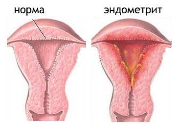 Причины, симптомы, методы лечения эндометрита | Он-Лайн Клиник |  Медицинский центр в Красноярске